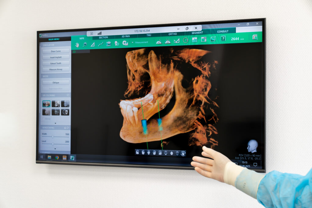 3D-Darstellung eines Unterkiefers mit digital geplanten Implantaten auf einem Monitor – moderne Implantatplanung mit computergestützter Technologie in der Zahnklinik Nordhorn.