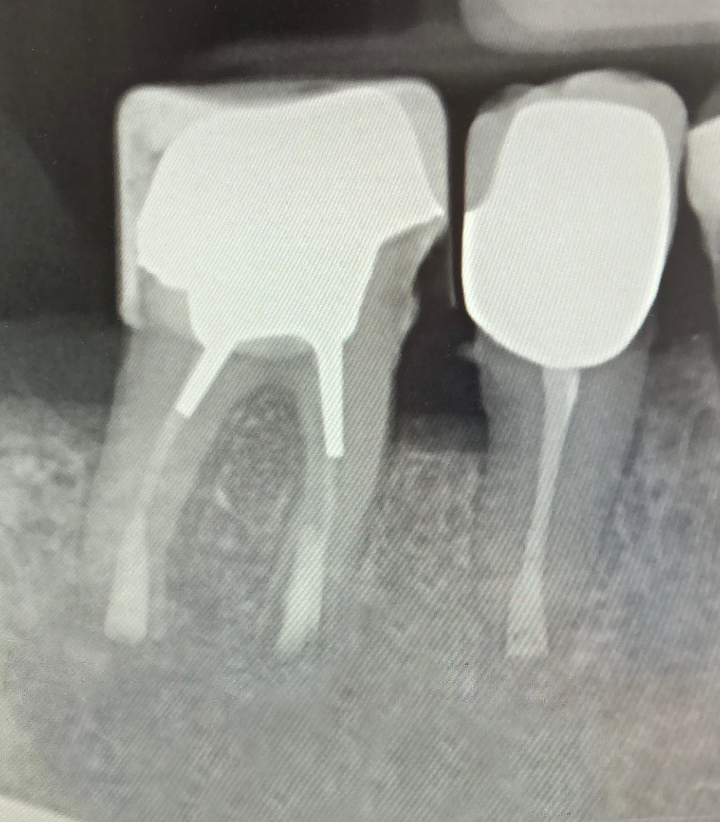 Röntgenaufnahme zweier behandelter Zähne mit Wurzelkanalfüllungen und Kronen. Die Aufnahmen zeigen die Zahnwurzeln, Wurzelfüllmaterialien und die umgebende Knochensubstanz.