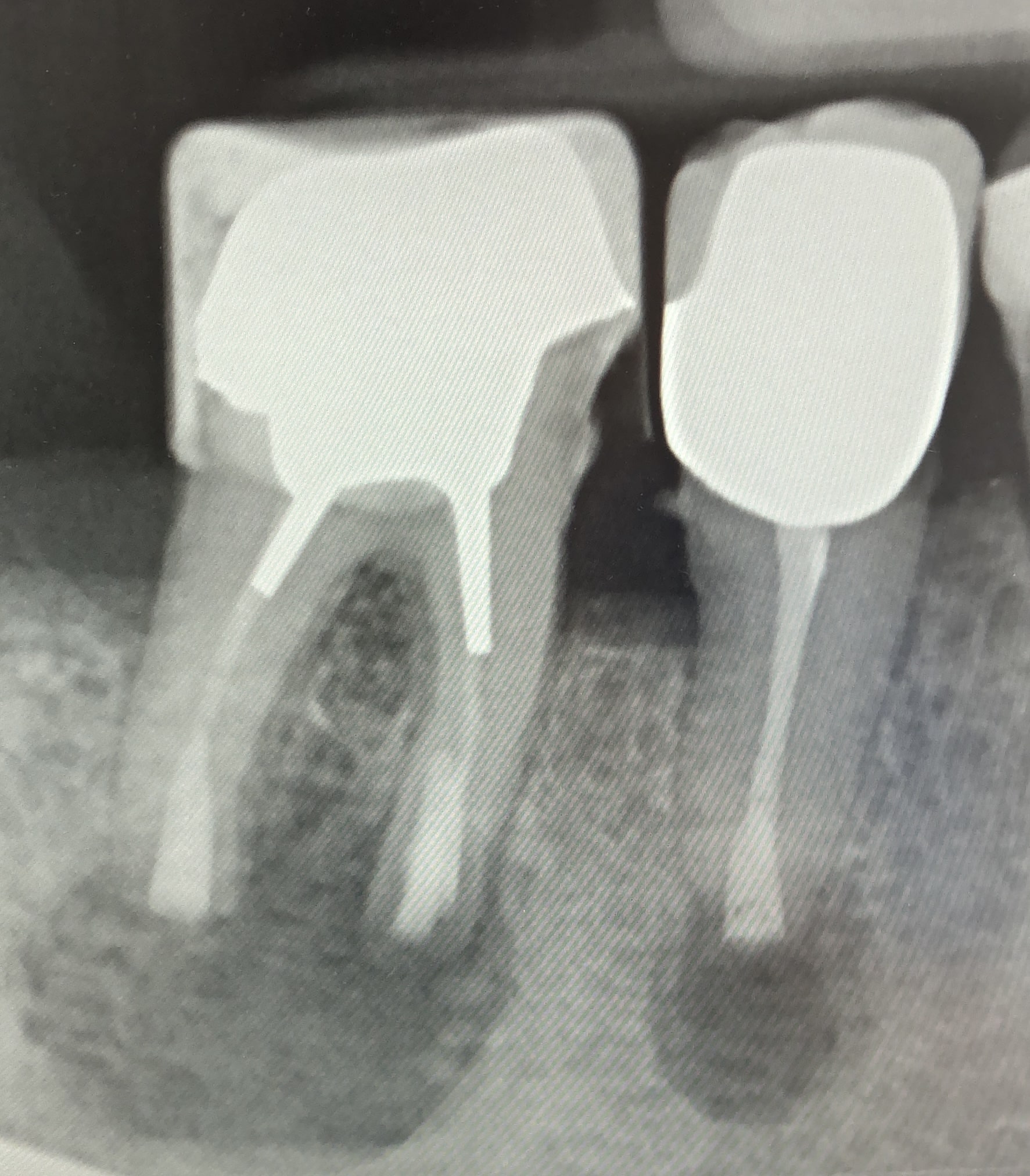 Röntgenaufnahme zweier ungehandelter Zähne mit Wurzelkanal Problemen. Die Aufnahmen zeigen die Zahnwurzeln und die umgebende Knochensubstanz.